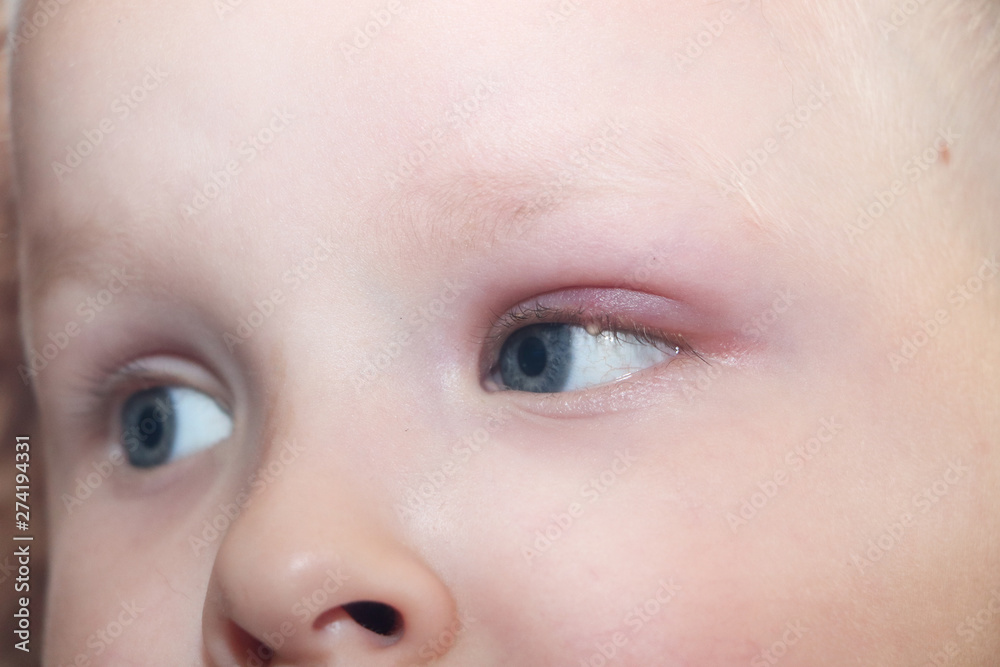 Barley, hordeolum in a child. Purulent pouch on the boy's eye Barley, hordeolum in a child. Purulent pouch on the boy's eye