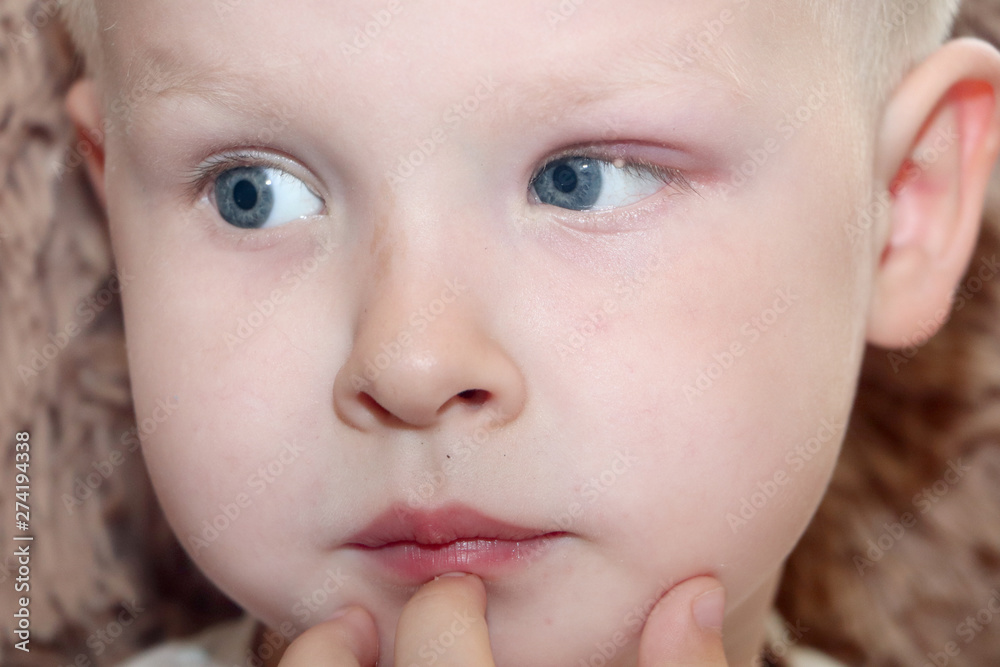 Barley, hordeolum in a child. Purulent pouch on the boy's eye Barley, hordeolum in a child. Purulent pouch on the boy's eye
