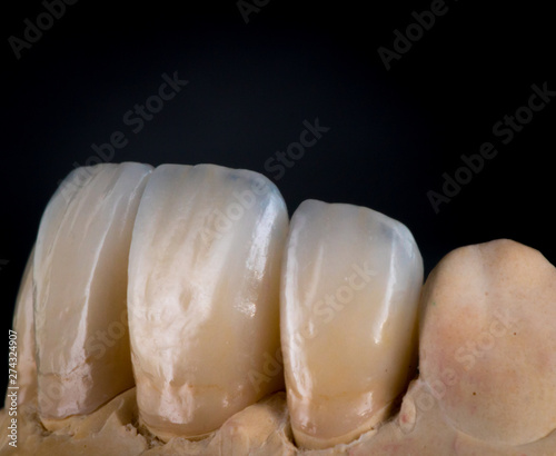dental veneers and crowns