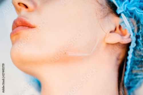Non-surgical mandibloplasty - the corners of the mandible - Painless and safe intradermal injections are effective for correcting mimic and senile wrinkles, including nasolabial triangle folds photo