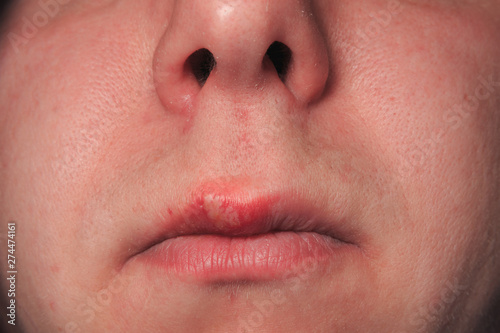 Second day of growing herpes on caucasian male man on front upper lip