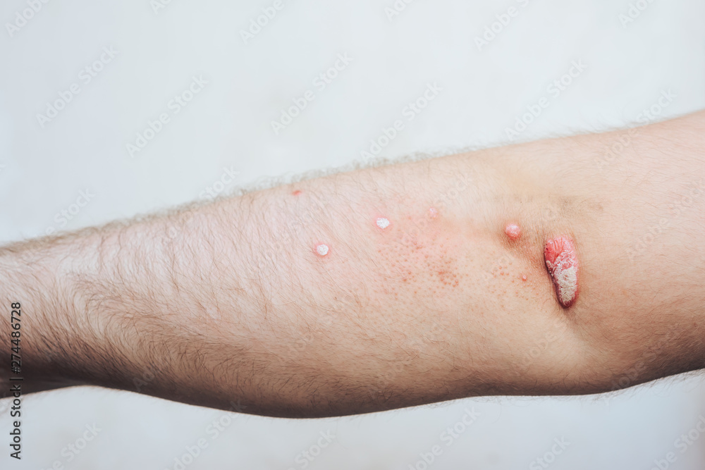 Close-up of irritation, rash on the skin of the human hand. Close-up of irritation, rash on the skin of the human hand.
