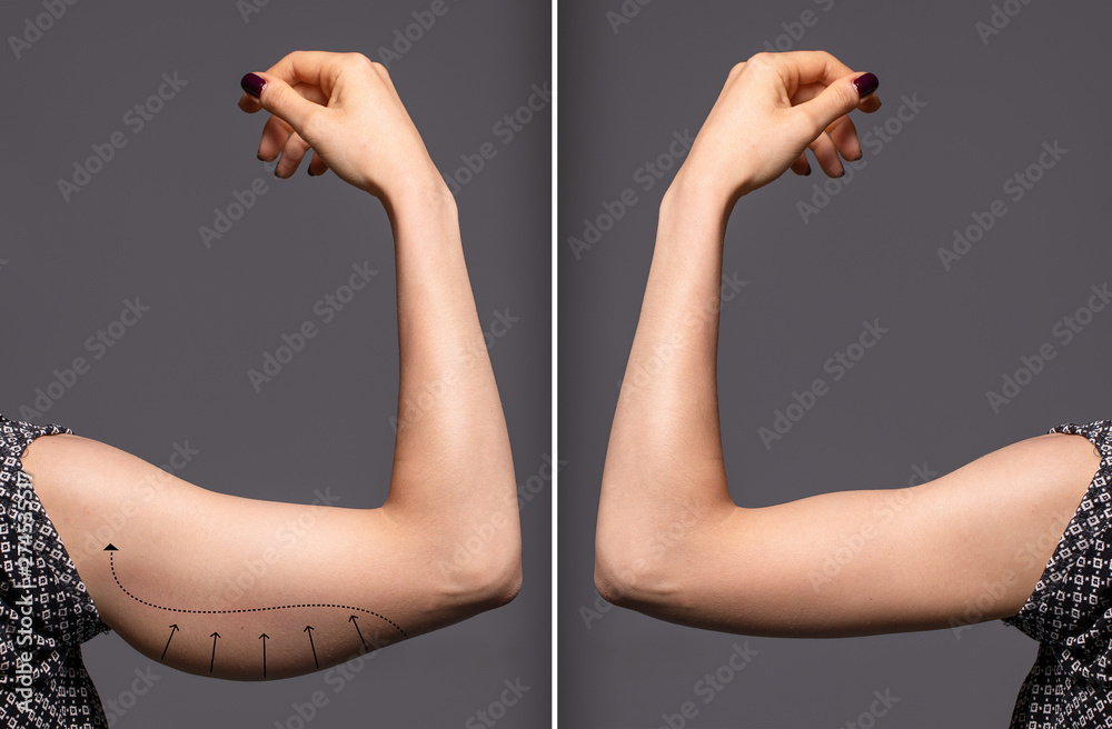 Woman arms with bat wings, comparison between before and after  brachioplasty surgery foto de Stock | Adobe Stock
