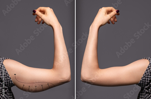 Fototapeta Woman arms with bat wings, comparison between before and after brachioplasty sur