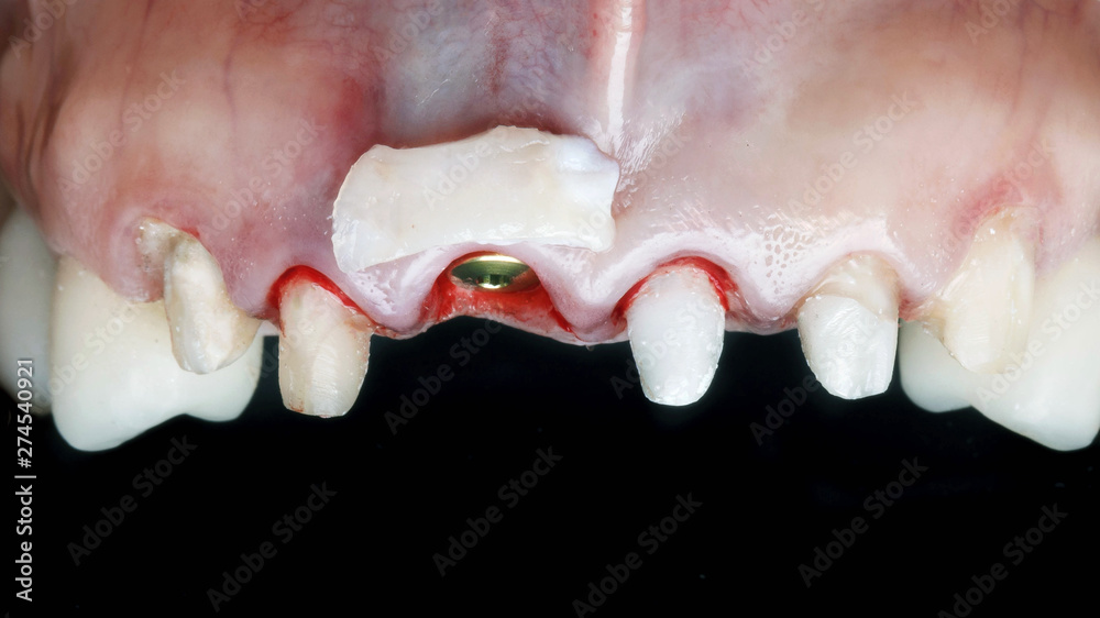 Obraz premium soft tissue on the gum for the mucosal volume