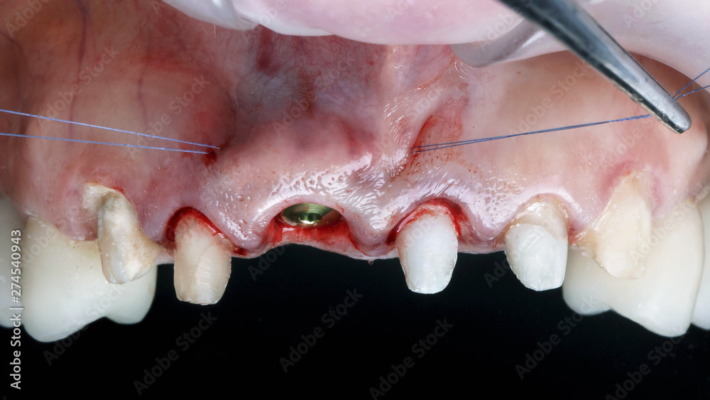 soft tissue closure after front tooth implantation