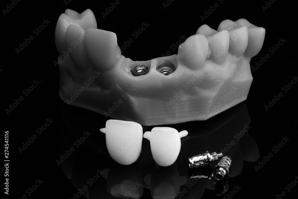 Dental model and standard gold abutments with crowns for mounting on