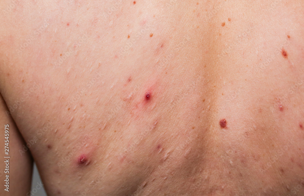 Many birthmarks on the girl's back. Medical health photo. Woman's oily skin with problems acne.