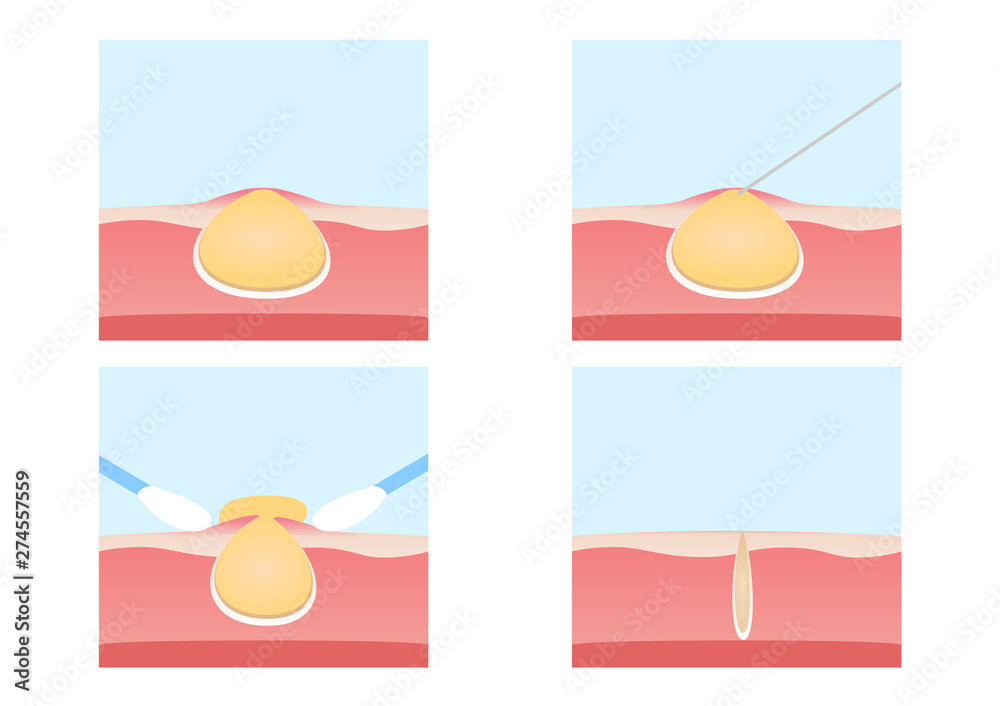 Acne and Pimples remove vector