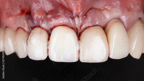 stitched and taut gums with crowns of the front teeth after implantation