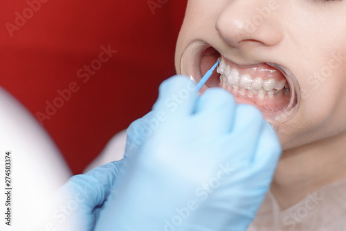 teeth whitening. preparation, the doctor applies the gel with a cotton swab
