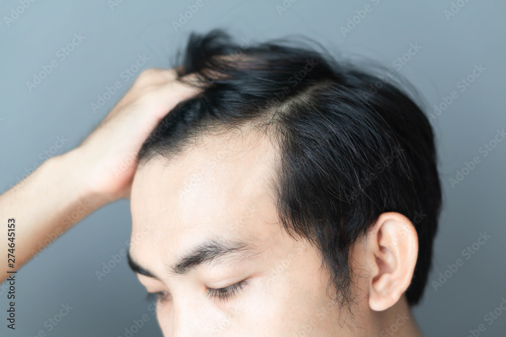 Young man serious hair loss problem for health care medical and shampoo product concept Young man serious hair loss problem for health care medical and shampoo product concept