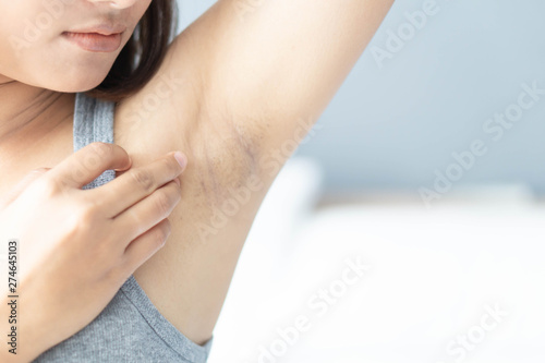Women problem black armpit lying on white bed background for skin care and beauty concept  selective focus