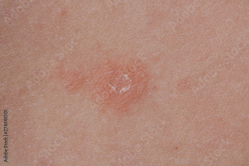 Pityriasis rosea three weeks after the appearance of the first focus on the skin of a young woman. A pink lichen is an approximation on the back. Gibera Syndrome.