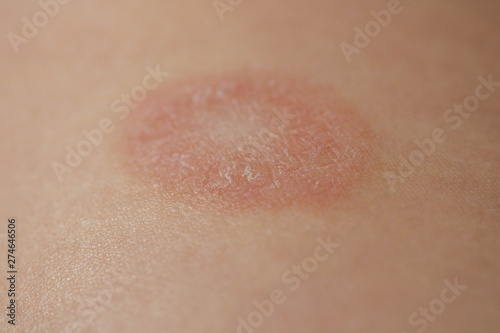 Pityriasis Rosea is a type of dermatitis with a mild pink or red skin rash and a flaky rash, maternal plaque, the first biggest papula. Gibera Syndrome. photo