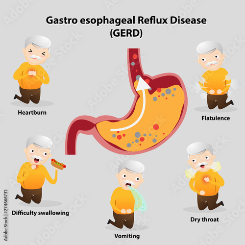 Gastro-Esophageal Reflux Disease (GERD)