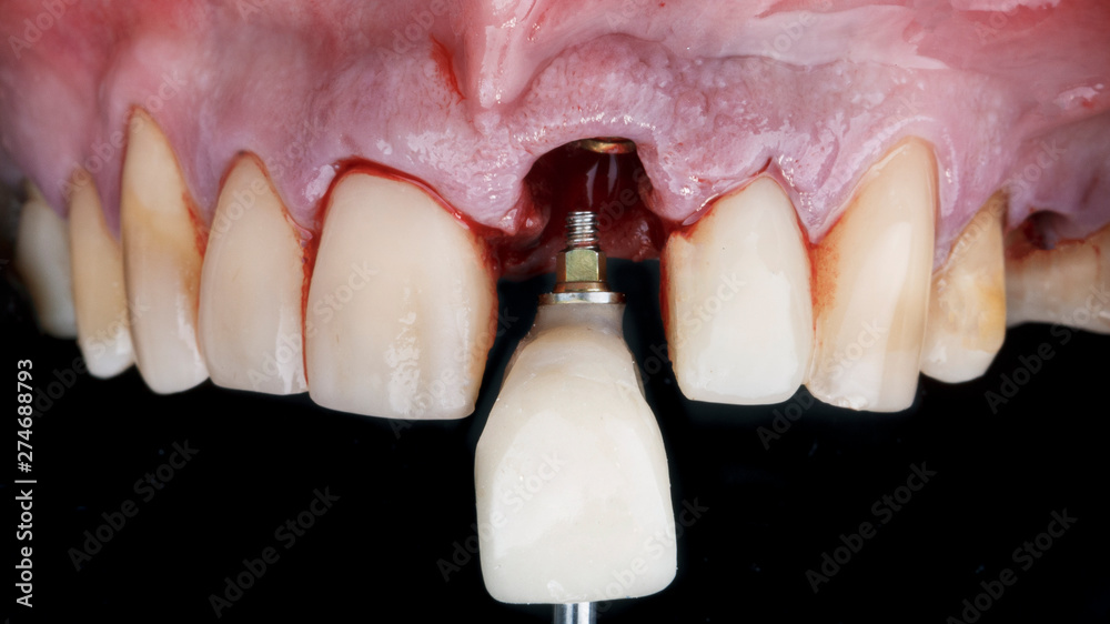 staging of the front tooth crown after implantation Stock Photo | Adobe ...