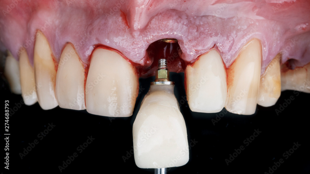 staging of the front tooth crown after implantation