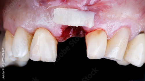 a flap of soft tissue on the gum of the front tooth
