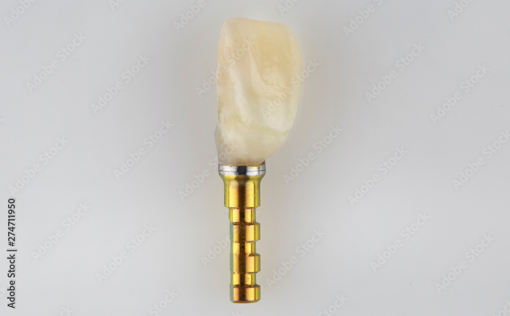 finished crowns from a natural tooth of the patient on a white background finished crowns from a natural tooth of the patient on a white background
