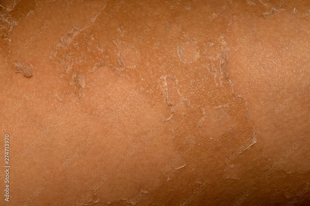 Fototapeta premium Allergic manifestations on the skin after sunburn.