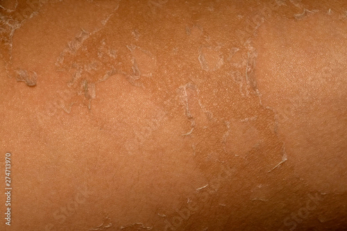 Allergic manifestations on the skin after sunburn.