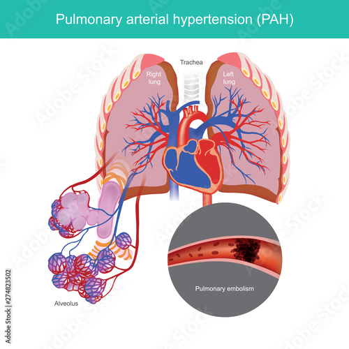 Condition of high blood pressure in the arteries that go from your heart to your lungs.