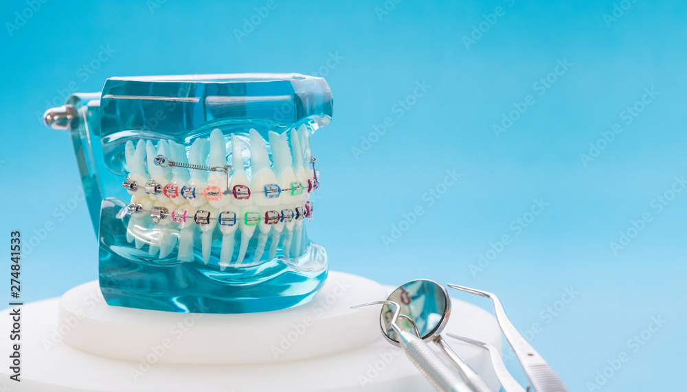 orthodontic model and dentist tool - demonstration teeth model of varities of orthodontic bracket or brace - obrazy, fototapety, plakaty 