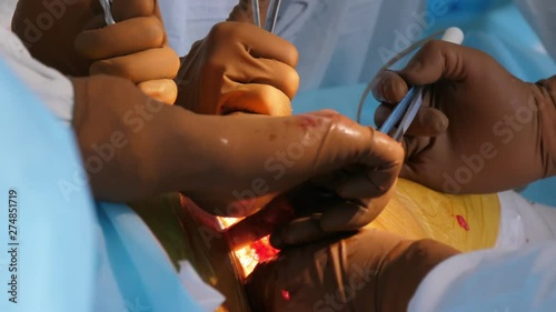 Many doctors holding long medical instruments in a cut patient`s leg in a room  photo