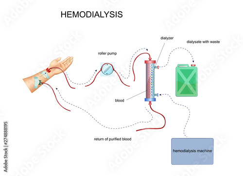 diagram of hemodialysis photo