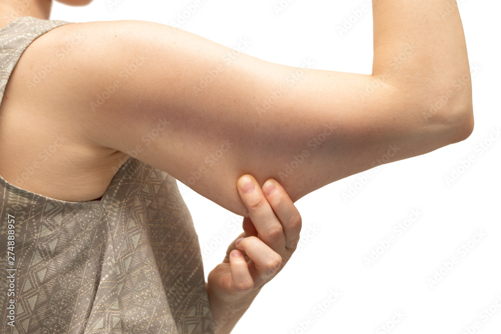 Bingo wings, female arm with loose skin Bingo wings, female arm with loose skin