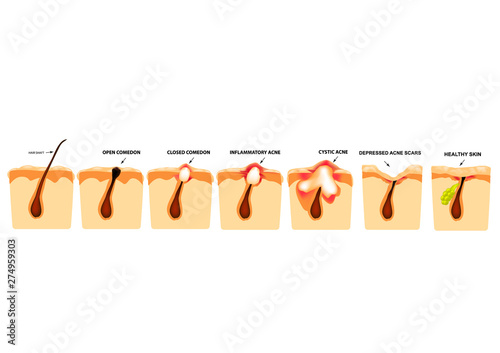 Types of acne. Closed comedones, open comedones, inflamed acne, cysts. Inflamed pimples. The structure of the skin. Scar acne and pimples. Infographics. Vector illustration on isolated background.