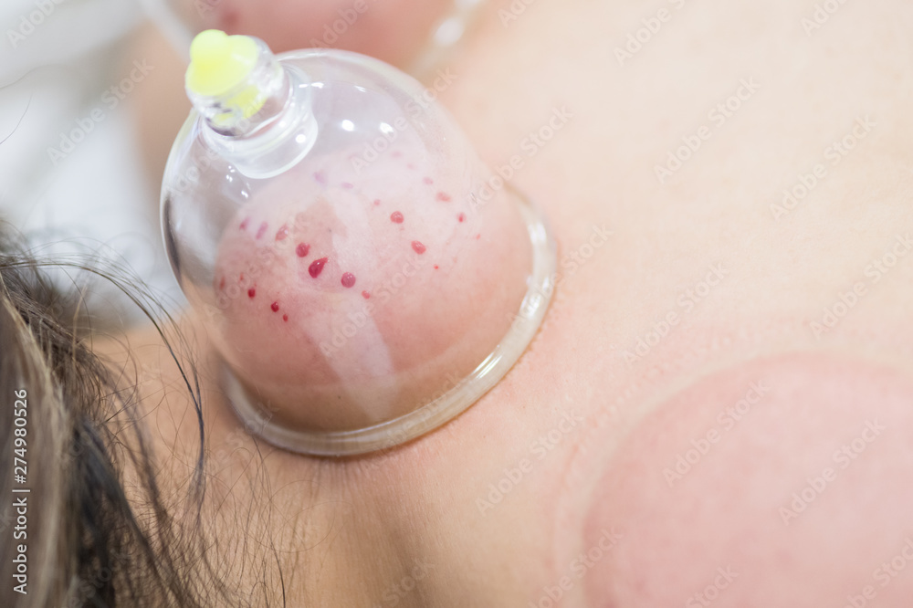 Hijama - the treatment of bloodletting. Attached vacuum cup. Scarification process. Hijama - the treatment of bloodletting. Attached vacuum cup. Scarification process.