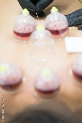 Hijama - the treatment of bloodletting. Attached vacuum cup. Blood fills in the cup.