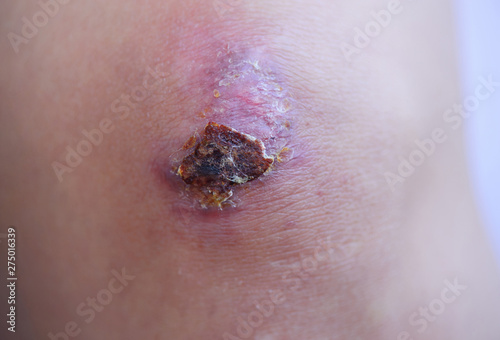 Photos Scar and scab (eschar) on asian female knee
