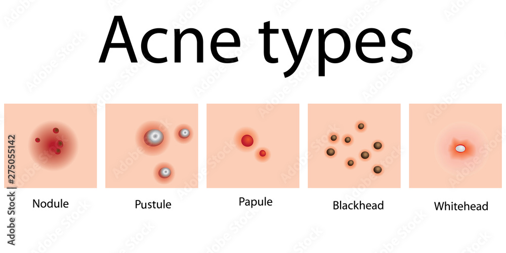 Obraz premium Acne types problem skin dermatology 