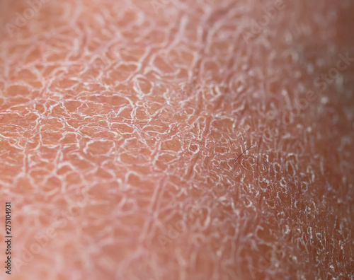 background of the texture of the skin is covered with small and large cracks and dead flaky scales photo