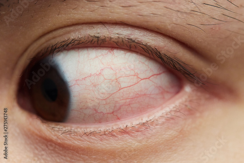 Bloodshot sick eyes close up