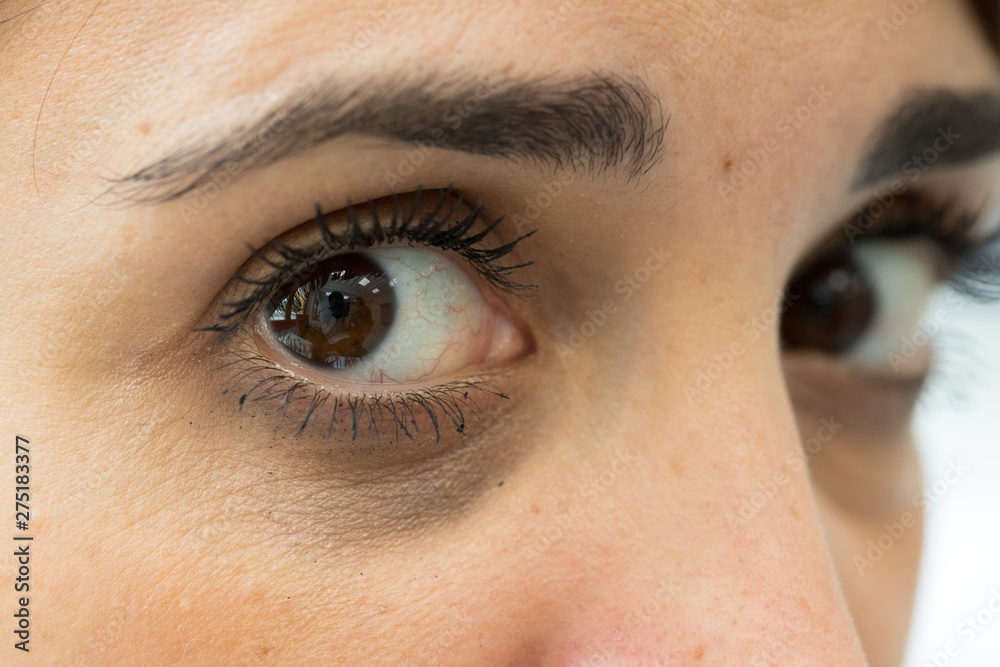 Fototapeta premium A close up view of a young woman with dark rings beneath her eyes. Appearance of bruised eye through lack of sleep and working long hours.