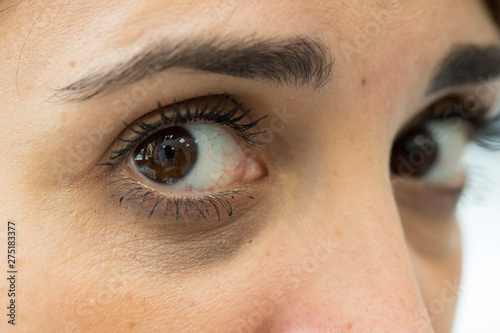 A close up view of a young woman with dark rings beneath her eyes. Appearance of bruised eye through lack of sleep and working long hours. photo