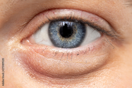 A macro view on the eye of a young Caucasian lady with blue iris. A swollen eyebag is seen beneath the eye (periorbital puffiness). A common symptom of an unhealthy and busy lifestyle.