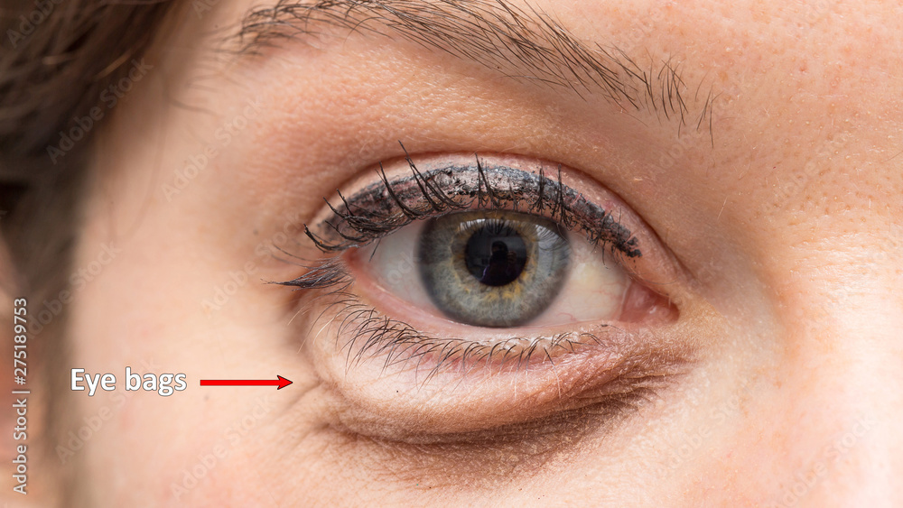 Puffy eyebags are seen close-up. Beneath the eye of a young Caucasian  woman. Fluid retention in the face caused by sleep deprivation and working  long hours. Stock Photo | Adobe Stock