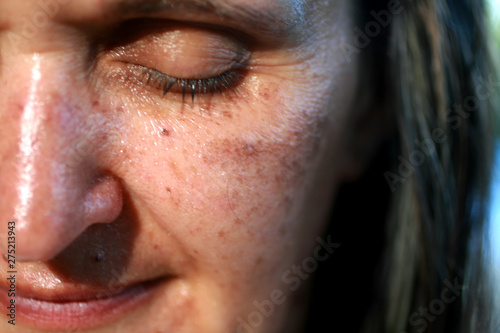 Pigmented spots on the face. Pigmentation on cheeks