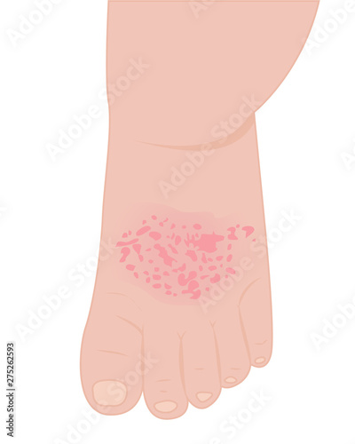 A baby foot affected with eczema 