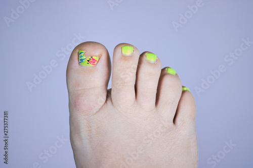 Close up of broken toe nail with cute painted. Even though the toenail is broken the women is being fun and positive. Horizontal  single