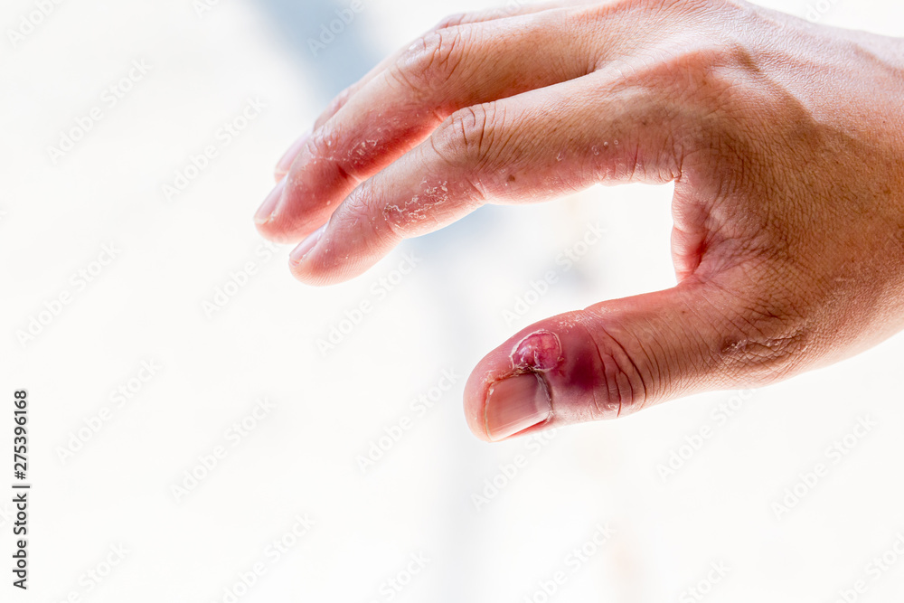 Paronychia, swollen finger with fingernail bed inflammation due to bacterial infection on a