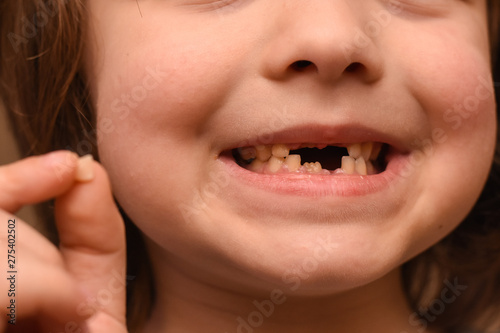 Happy boy smiling and showing his milk-tooth that has fallen out. Child lost milk tooth