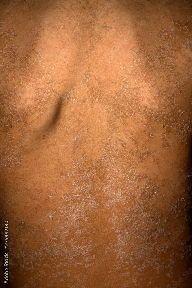 The manifestation of skin allergic dermatitis.