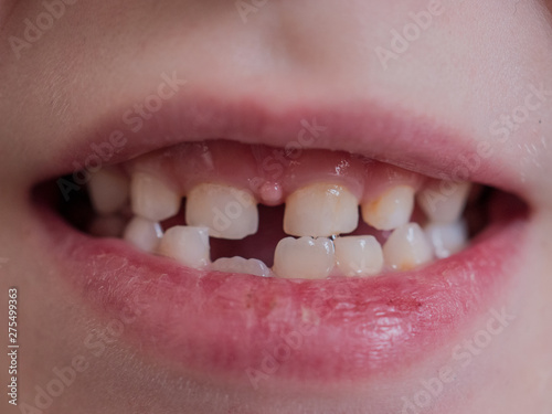 Cute baby shows dropped baby tooth. Child smiles with toothless mouth. Lips and teeth close up