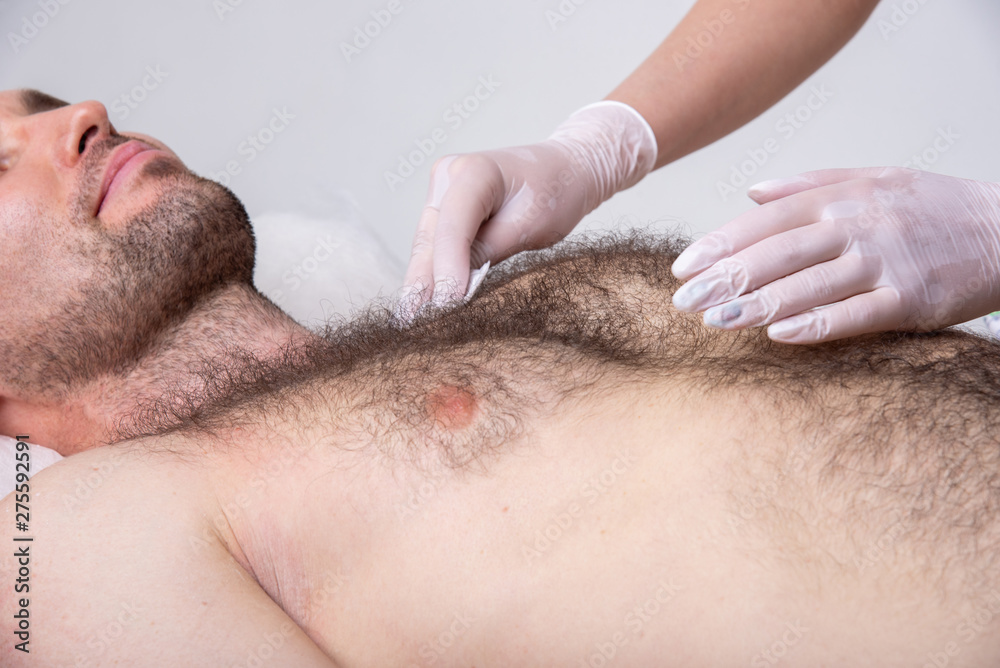 Handsome man with a lot of hair on his chest. Professional depilation doctor in white gloves prepares and disinfects the skin before waxing. Handsome man with a lot of hair on his chest. Professional depilation doctor in white gloves prepares and disinfects the skin before waxing.